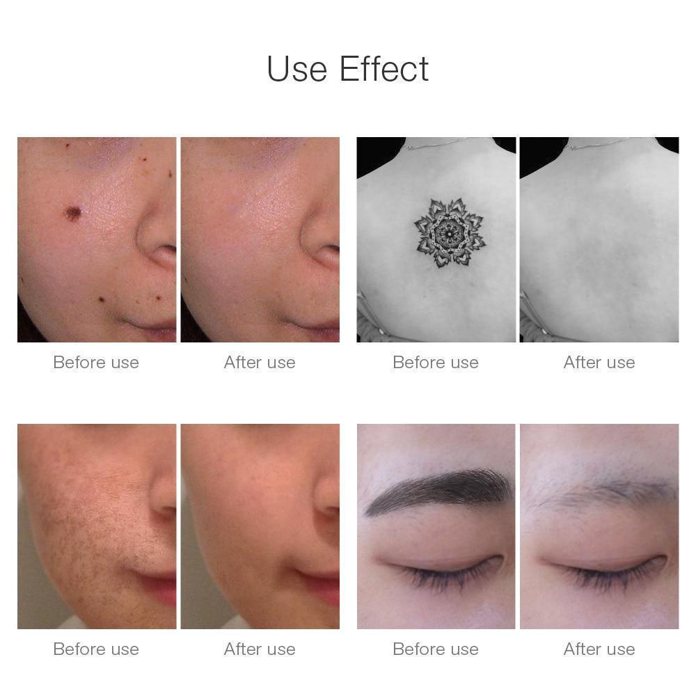 Instant Laser Dark Spot & Tattoo Remover