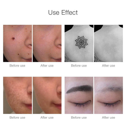 Instant Laser Dark Spot & Tattoo Remover